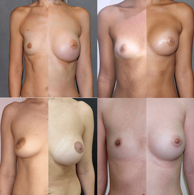 Foto antes e despois da mamoplastia do peito