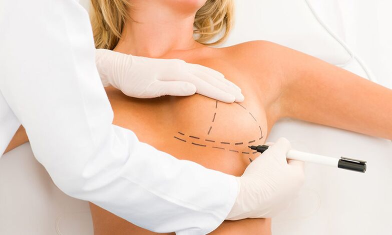 Marca de mama de mamoplastia