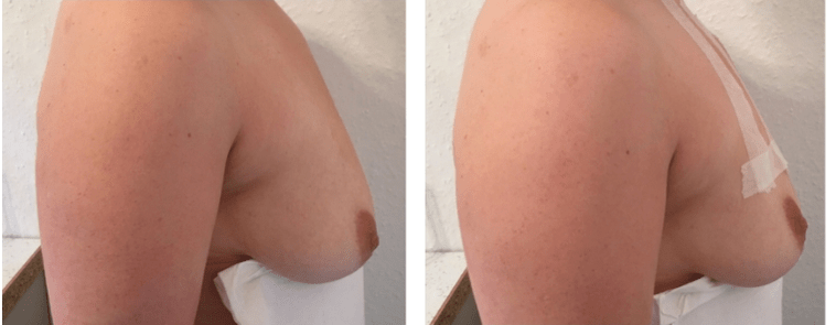 Antes e despois de levantamento de peito con fío