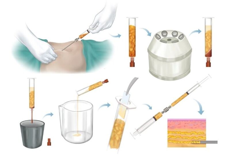 Eliminación de graxa das áreas problemáticas, procesamento e inxección no tecido mamario