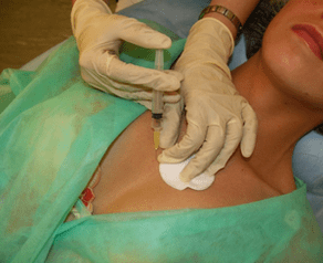 Introdución de meso-cóctel no tecido mamario - unha alternativa ás inxeccións de ácido hialurónico