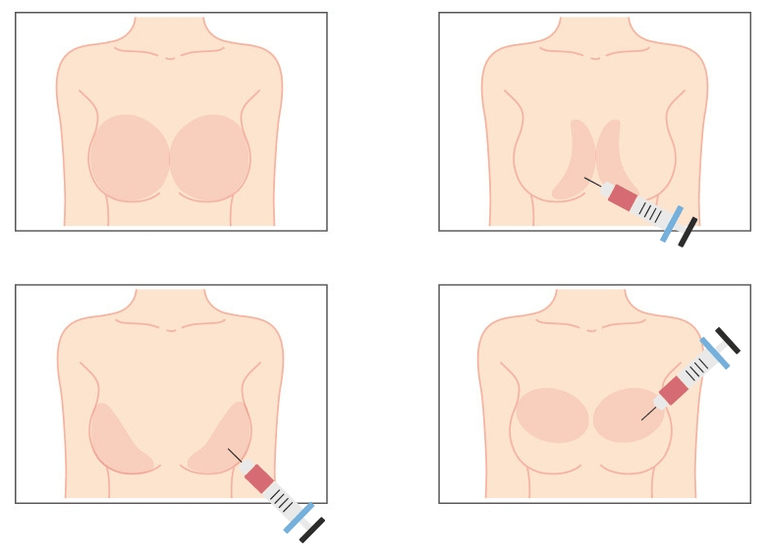 Lugares para a inxección de ácido hialurónico no peito
