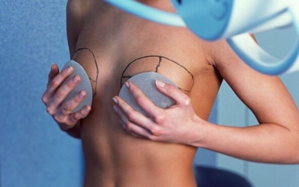 aumento mamario con implantes