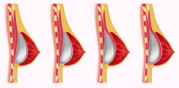 métodos de instalación de implantes para a ampliación de mama